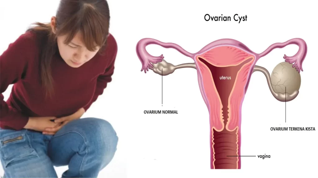 penyakit kista