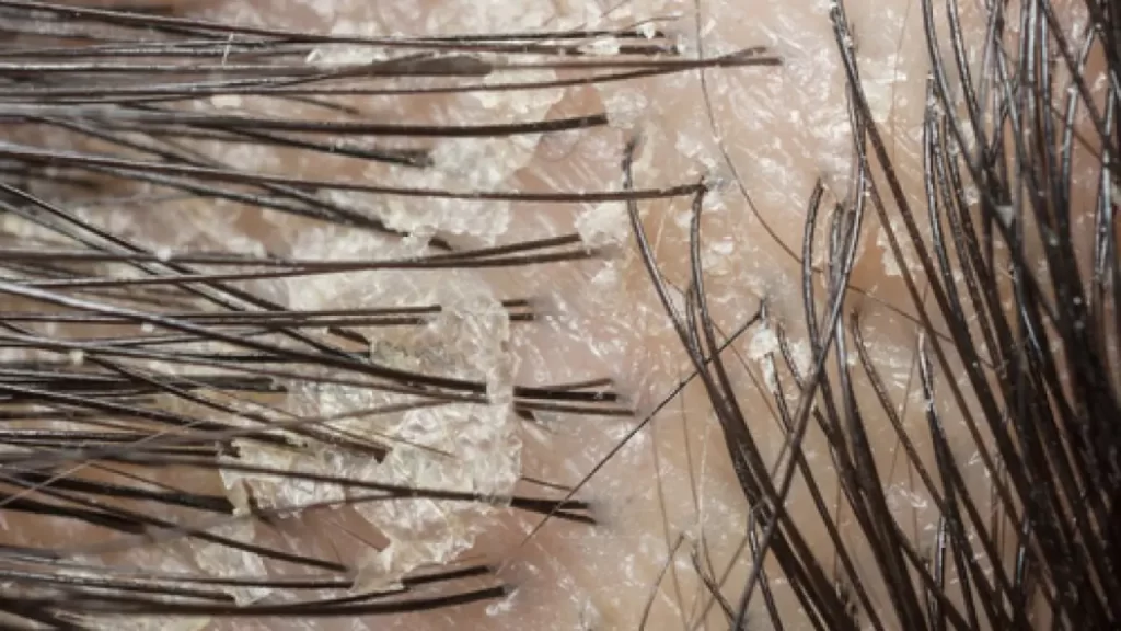 Cara Menghilangkan Ketombe