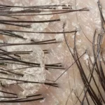 Cara Menghilangkan Ketombe