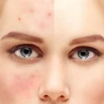 Tips Mengatasi Jerawat dan Bruntusan