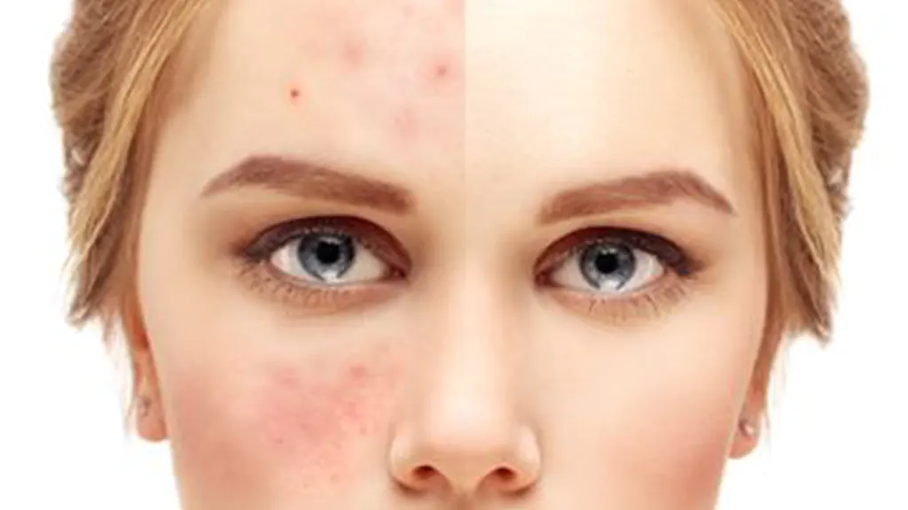 Tips Mengatasi Jerawat dan Bruntusan