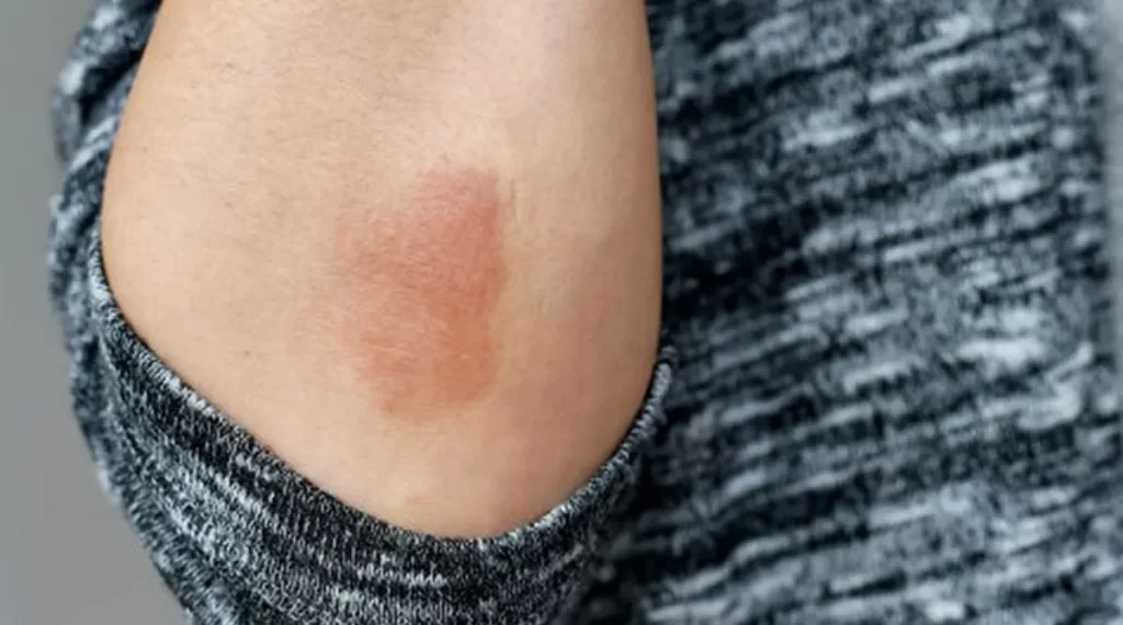 Kadas Menular atau Tidak