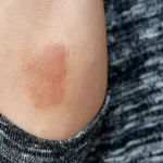 Kadas Menular atau Tidak