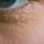 Cara Menghilangkan Bintik-bintik Kecil di Wajah Seperti Biang Keringat