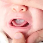 Cara Menghilangkan Putih di Lidah Bayi