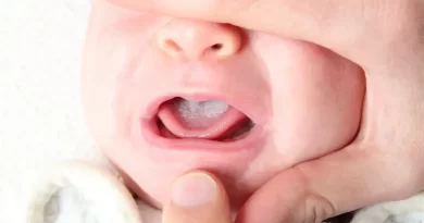 Cara Menghilangkan Putih di Lidah Bayi