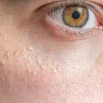 Cara Menghilangkan Milia yang Sudah Bertahun-tahun