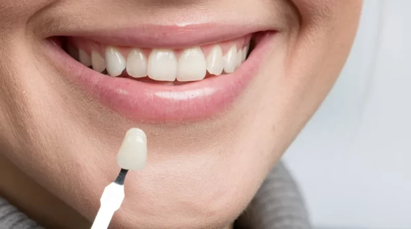 Manfaat Veneer Gigi dan Berapa Harganya?