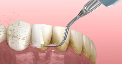 Harga Membersihkan Karang Gigi di Puskesmas dan Klinik Dokter Gigi