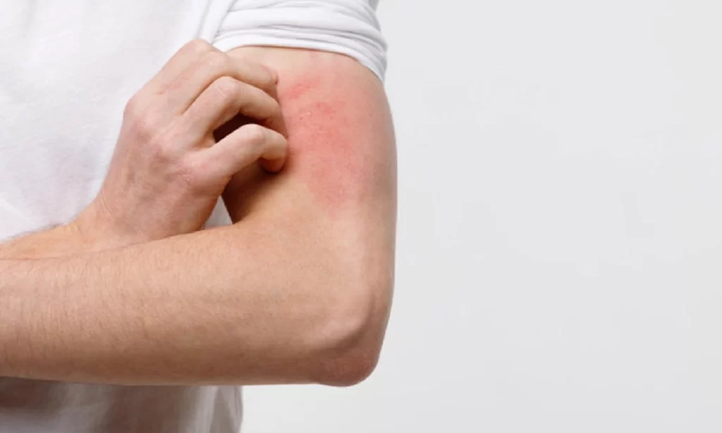 Bintik Merah Gatal Menyebar