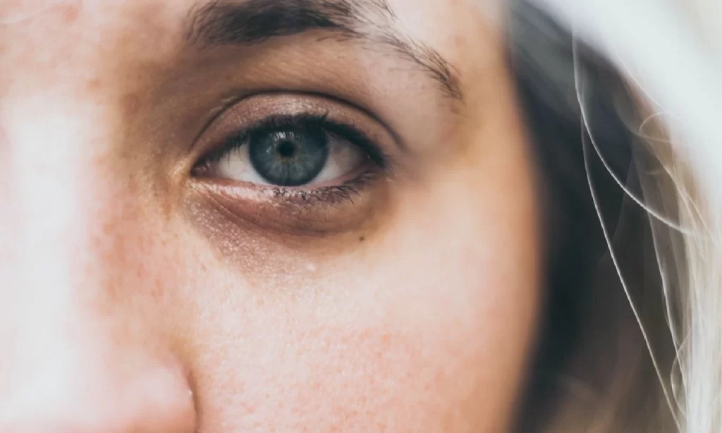 Cara Menyembuhkan Mata Panda