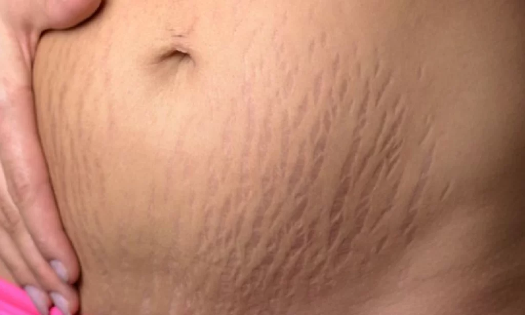 Cara Menghilangkan Stretch Mark