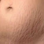 Cara Menghilangkan Stretch Mark