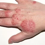 Penyakit Kulit Eksim