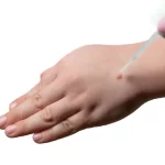 Obat Kutil: Pengobatan Efektif untuk Mengatasi Masalah Kutil