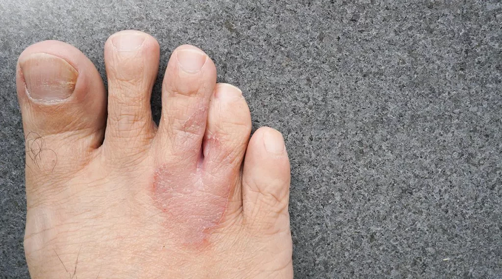 Cara Mengobati Kutu Air yang Sudah Parah