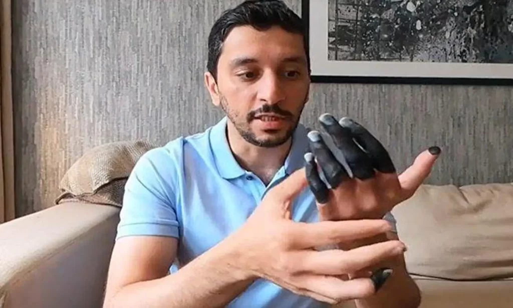 Bahaya Frostbite: Pengertian, Gejala, Penyebab, dan Cara Menanganinya