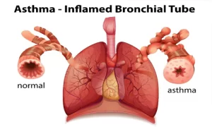 patofisiologi asma bronkial