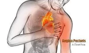 kode icd 10 angina pectoris