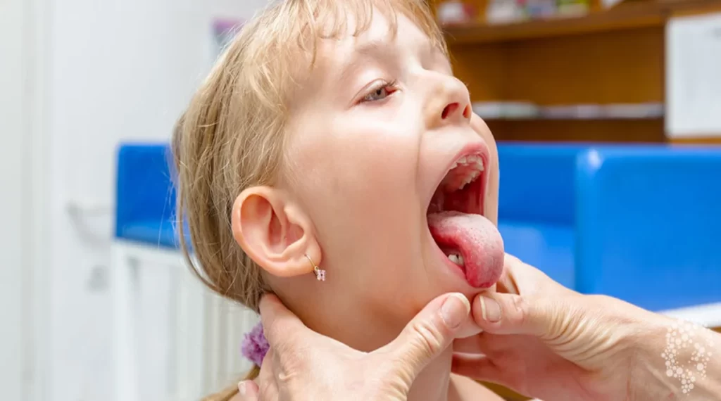 kode icd 10 tonsillitis