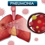 Kode ICD 10 Bronchopneumonia untuk Infeksi Radang Paru-Paru yang Disebabkan oleh Virus, Bakteri, dan Jamur