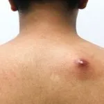 Bisul atau abses kulit adalah pembengkakan